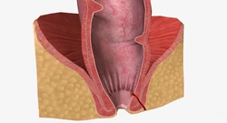 Anal Fistula: Signs, Symptoms & Importance of Early Treatment